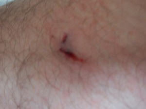 Partially-chewed leg